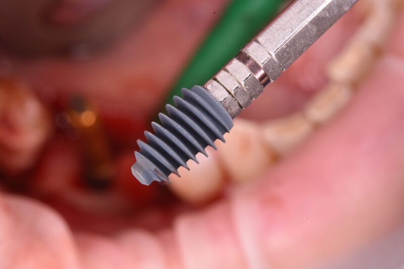 surub-implant-dentar